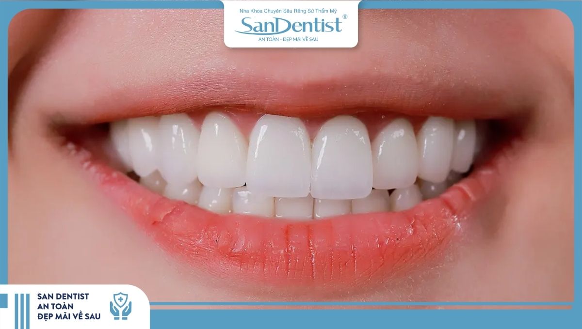 Bạn cần biết chi phí trồng răng sứ để chuẩn bị tài chính phù hợp