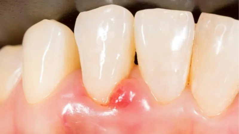 Bị viêm lợi có nên lấy cao răng hay không?