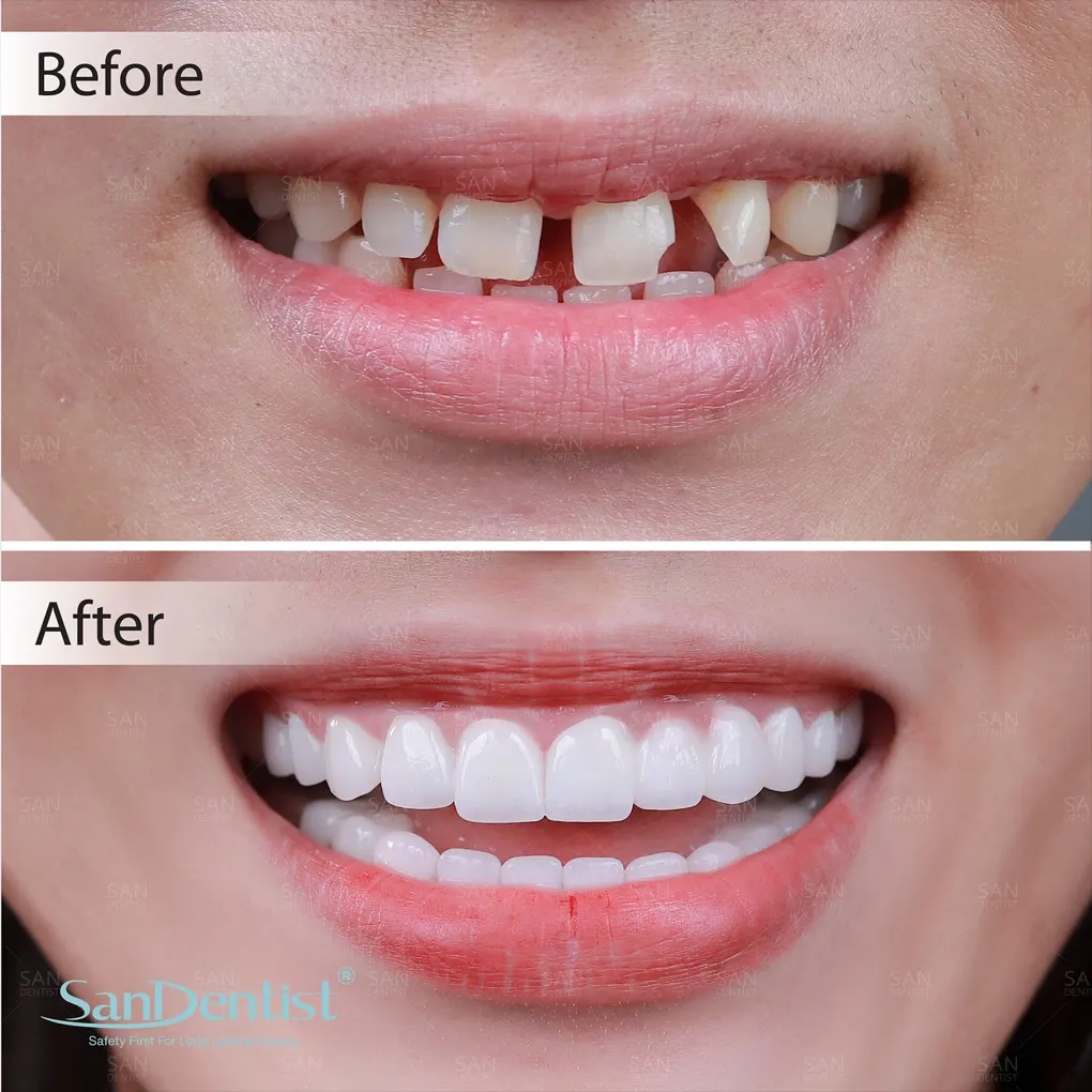 Dán sứ Veneer có gây hôi miệng hay không?