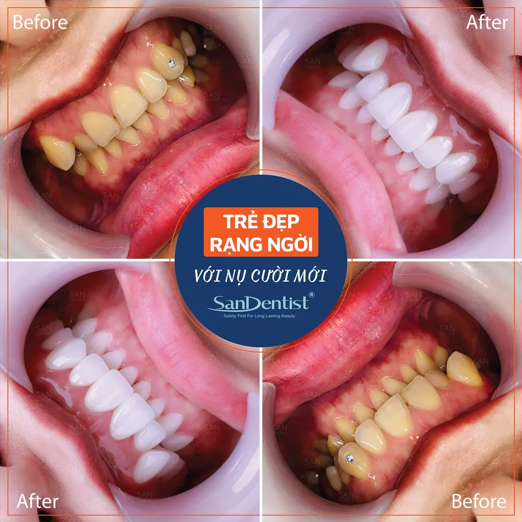 Dán sứ veneer có mài răng hay không?