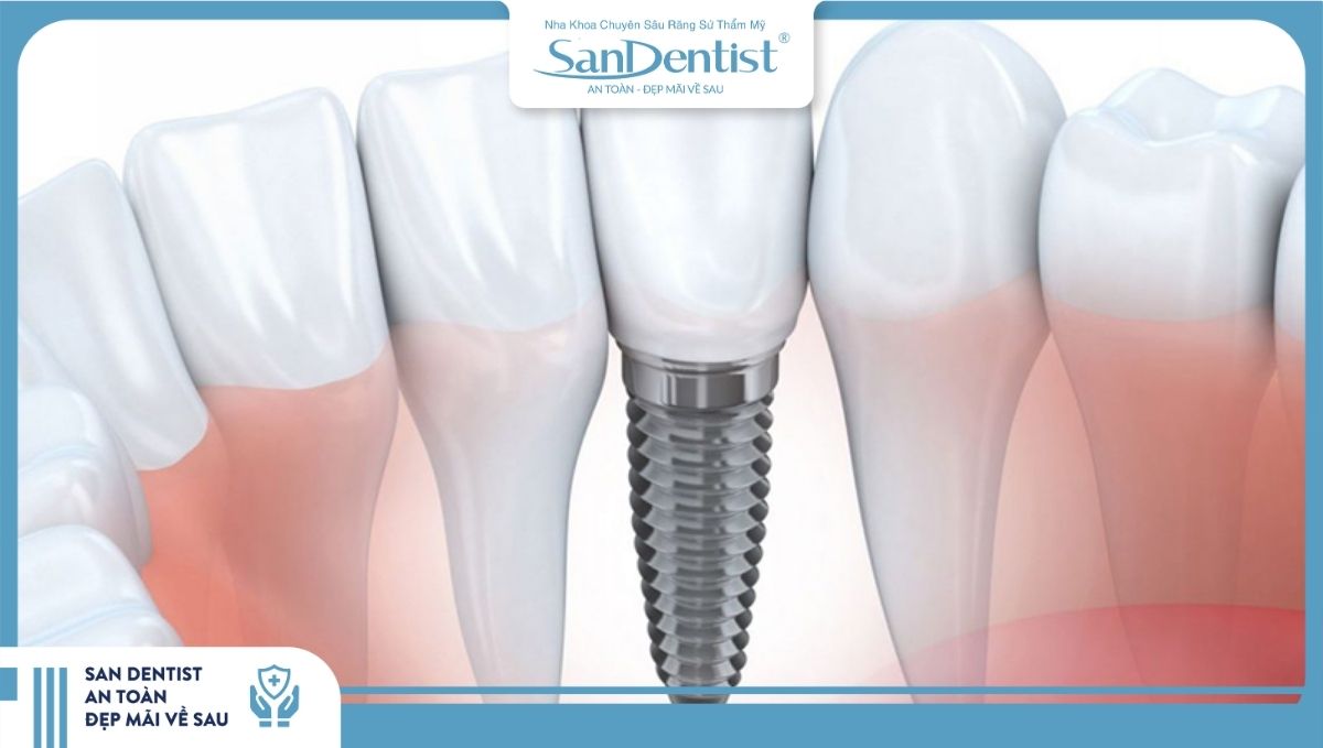 Hiểu lầm về trồng răng sứ và trồng răng Implant có thể dẫn đến nhận định sai về chi phí điều trị