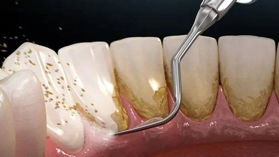 Lấy cao răng có điều trị hôi miệng được không?