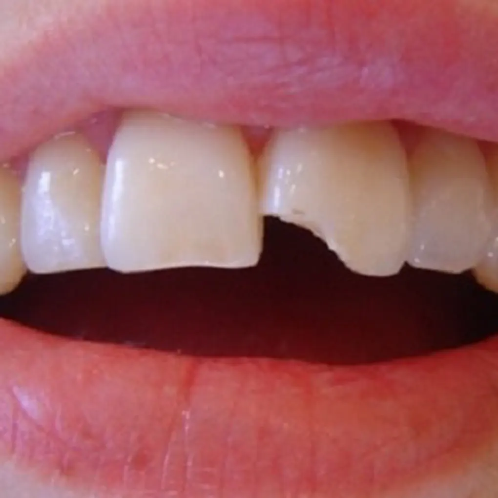 Những điều cần lưu ý khi hàn răng mẻ?