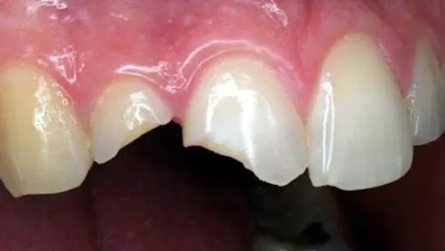 Những điều cần lưu ý khi hàn răng mẻ?