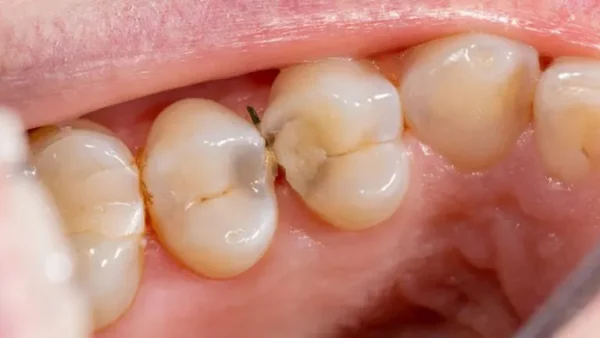 Sâu khe răng: Nguyên nhân và cách khắc phục?