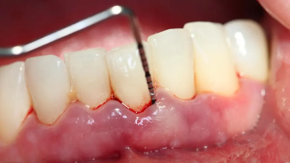 Sâu răng bị chảy máu có nguy hiểm hay không?