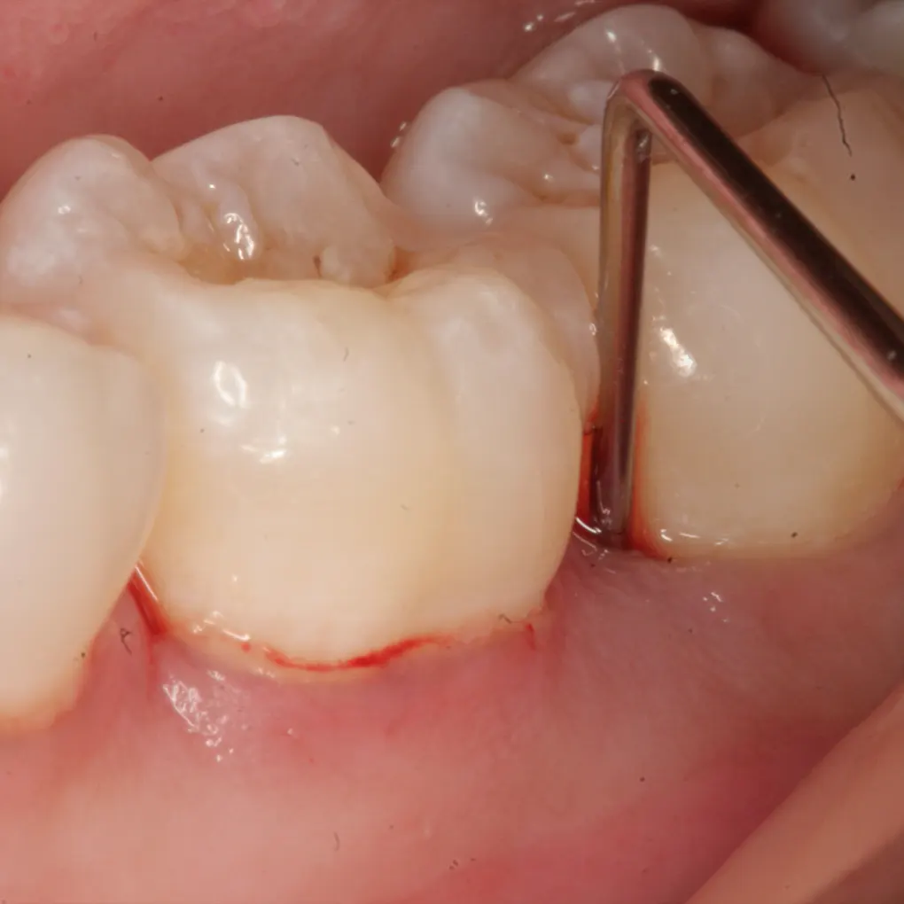 Sâu răng bị chảy máu có nguy hiểm hay không?