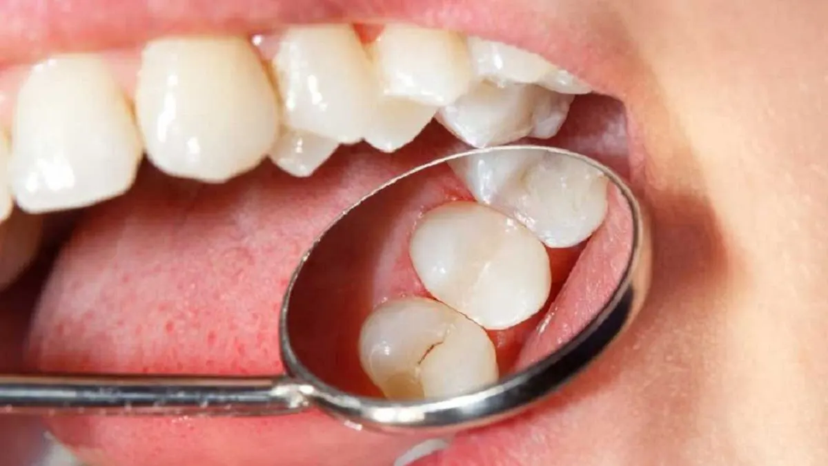 Sâu răng nên kiêng ăn những gì để không nghiêm trọng hơn?