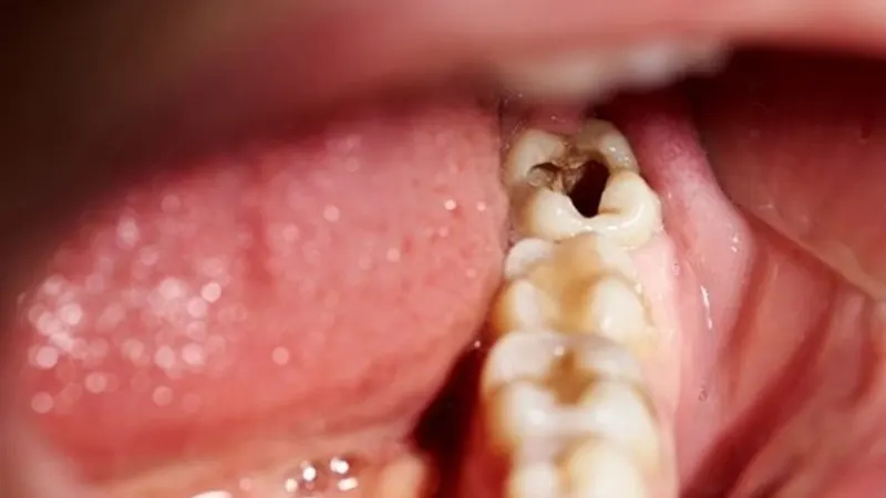Sâu răng hàm: Nguy hiểm không lường đến sức khỏe