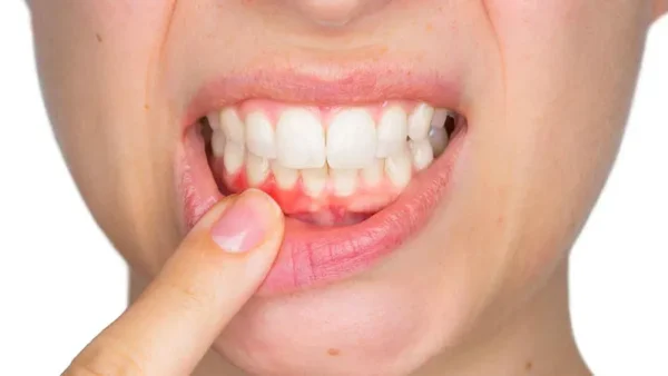 Viêm lợi nên ăn gì và không nên ăn gì?