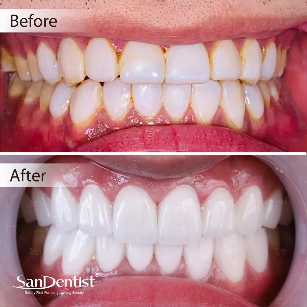 Điều trị dứt điểm tình trạng hôi miệng kinh niên