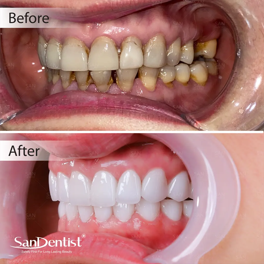 Điều trị tủy răng cho trẻ có nguy hiểm không?