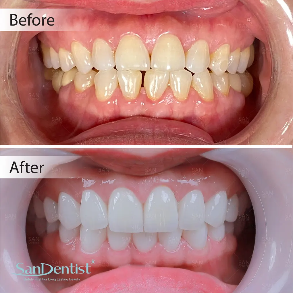 Điều trị tủy răng sâu kết hợp phủ răng sứ được không?