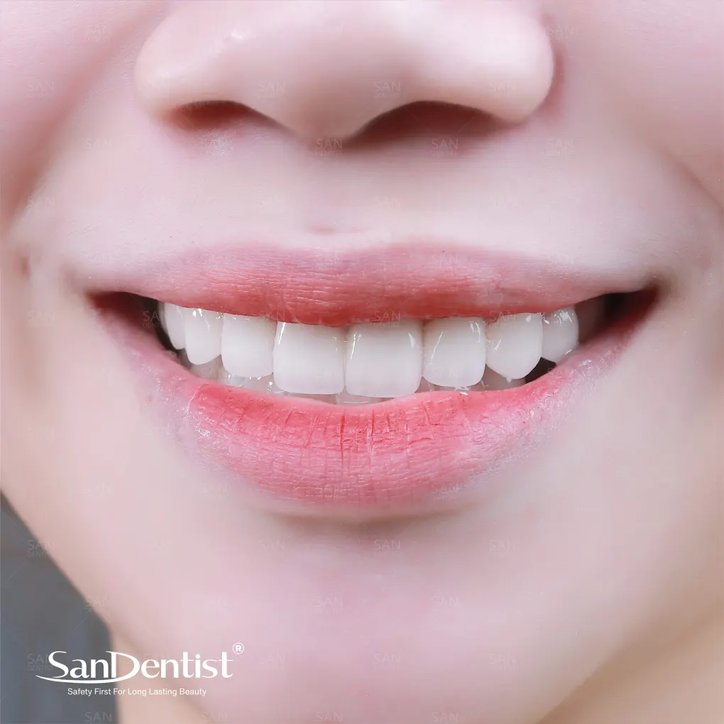 Mất răng do bệnh sâu răng và viêm nha chu