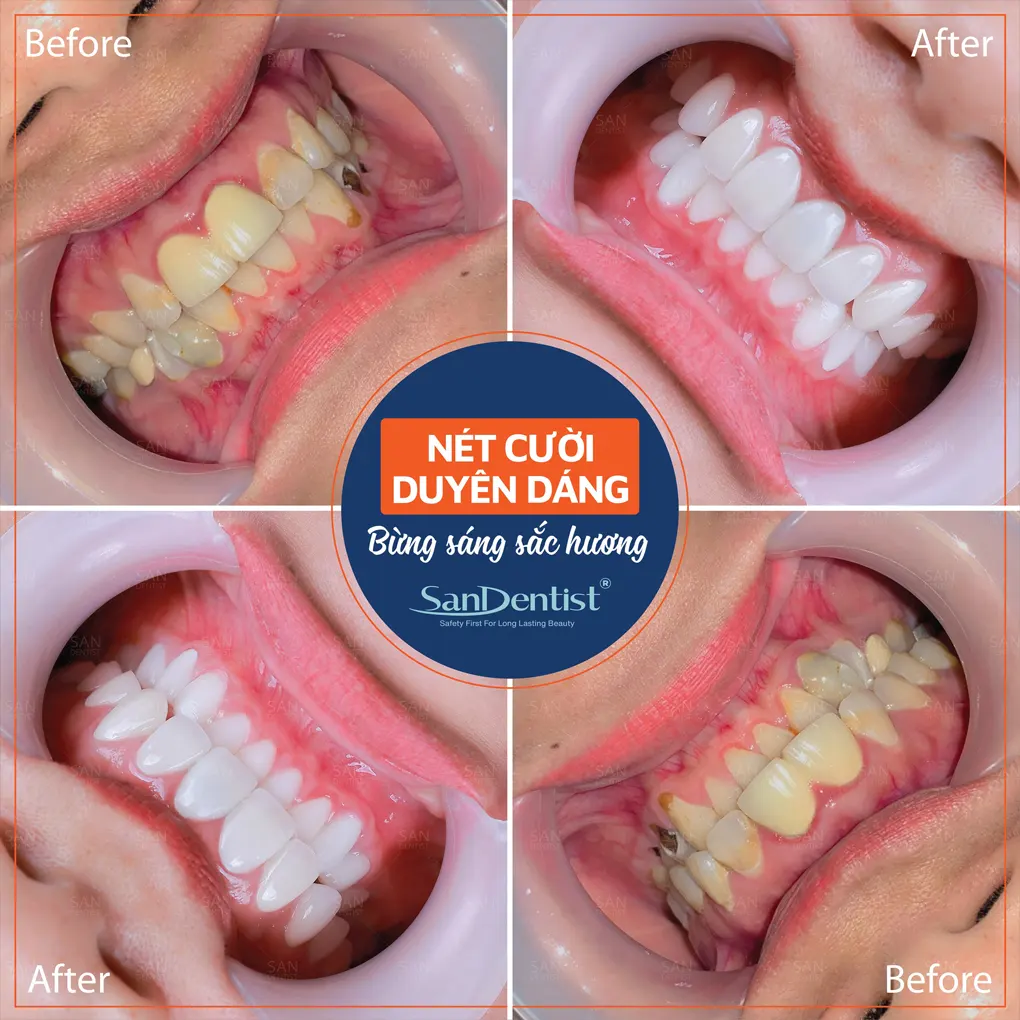 Những cách chăm sóc răng sau phẫu thuật