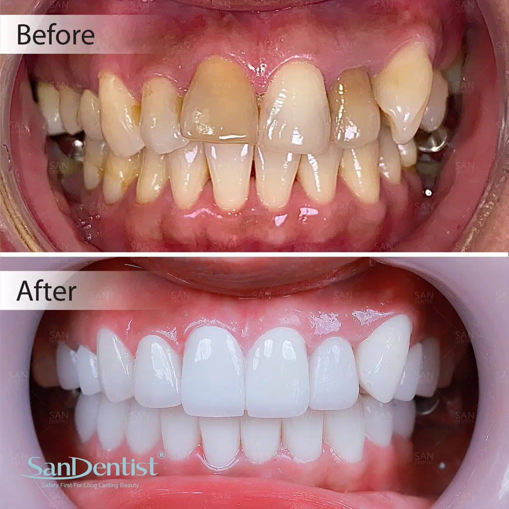 Những điều cần lưu ý khi bị sưng nướu răng có mủ