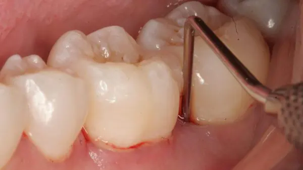 Những điều cần lưu ý khi bị sưng nướu răng có mủ