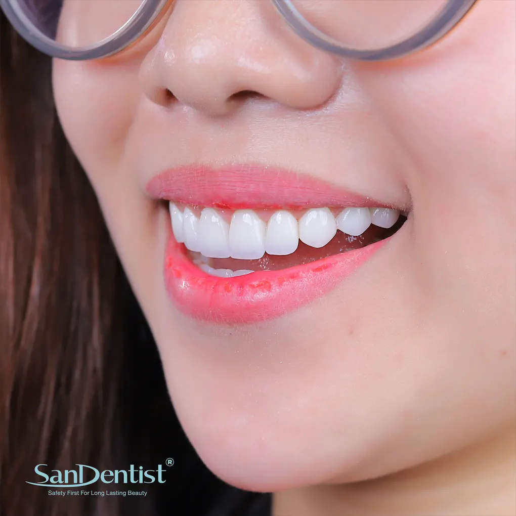 Những trường hợp nên thực hiện dán sứ veneer