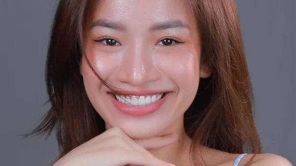 Những trường hợp nên thực hiện dán sứ veneer