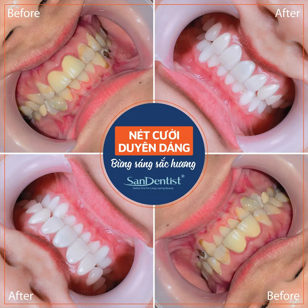 Những trường hợp nên thực hiện dán sứ veneer