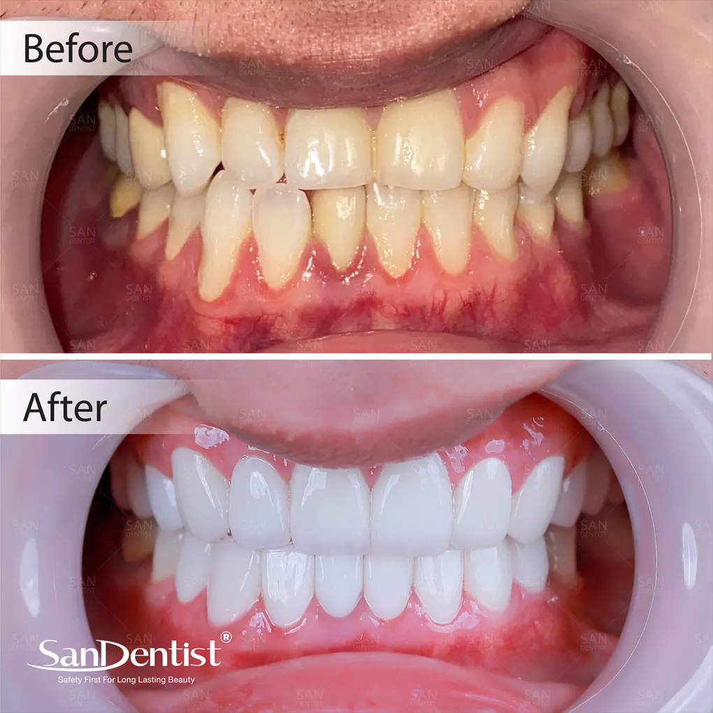 Răng sâu bị vỡ có dẫn đến mất răng vĩnh viễn không?