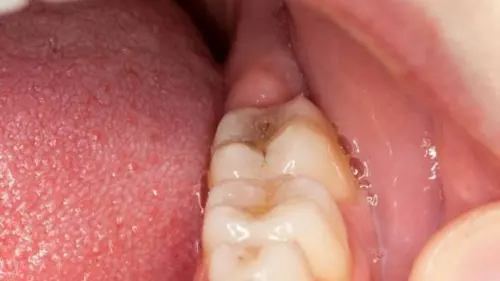 Viêm lợi có phải nhổ bỏ răng hay không?