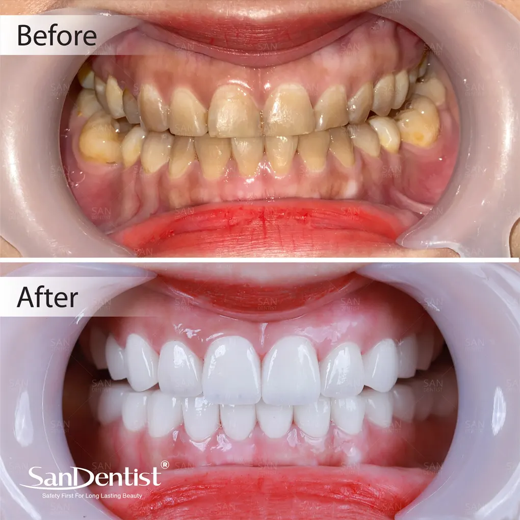 Vôi răng có tự bong tróc được hay không?