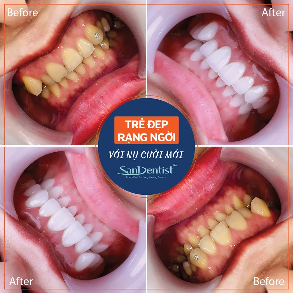 7 thói quen xấu khiến răng ố vàng