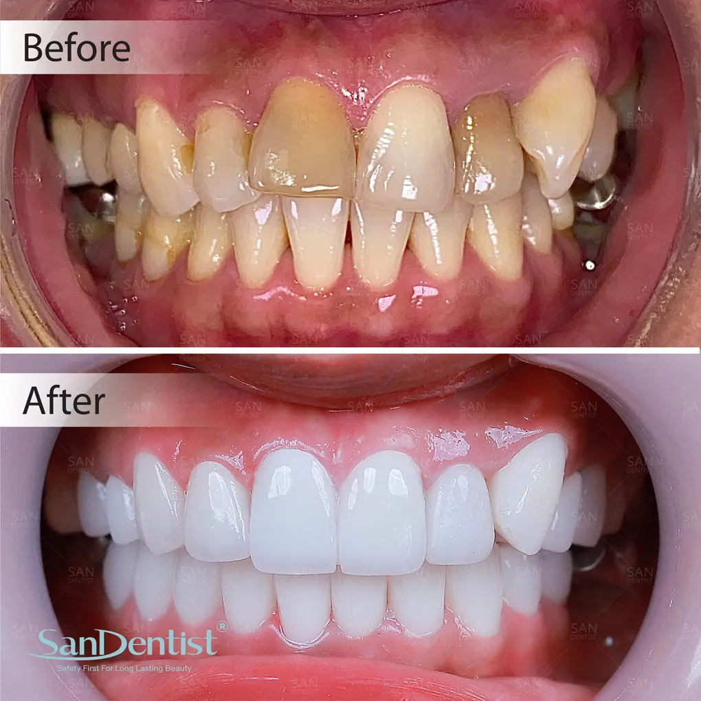 Hậu quả của tình trạng răng bị mài mòn mặt nhai