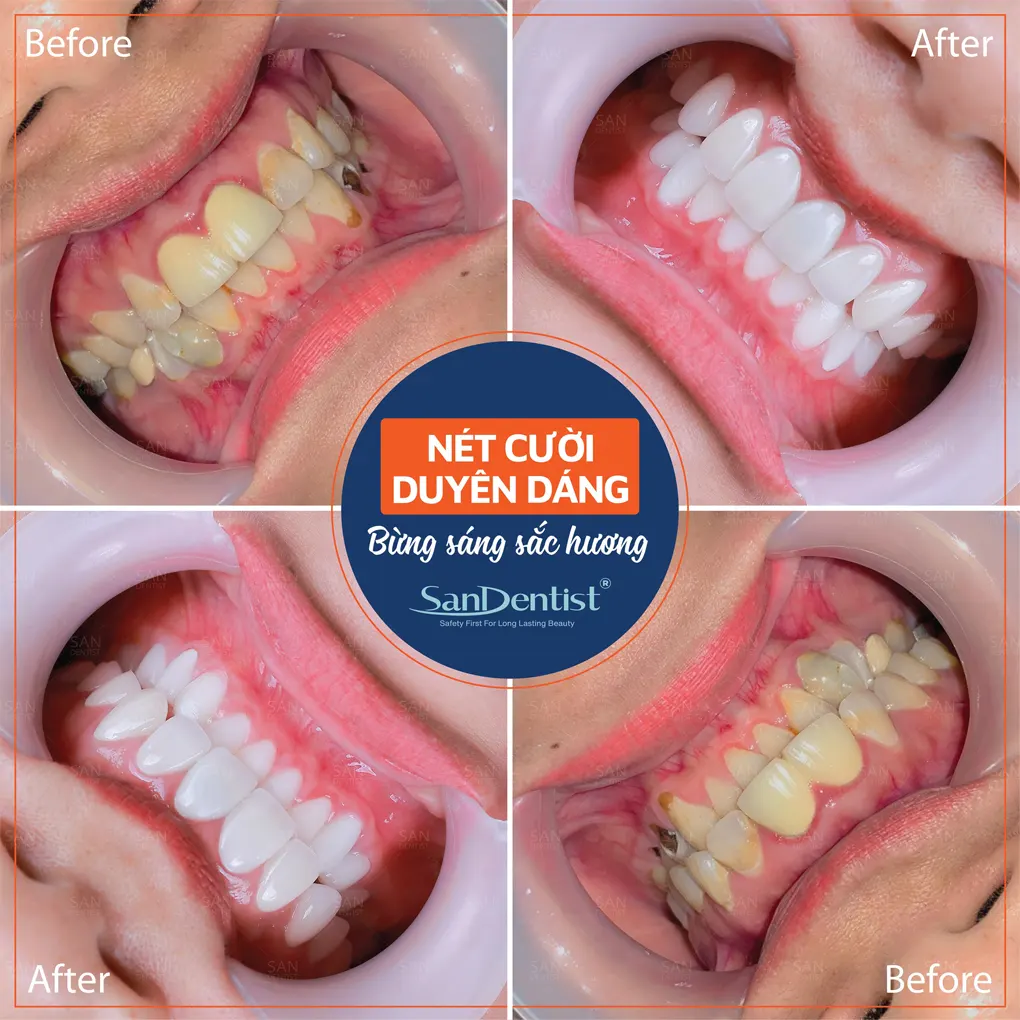 Mài nhỏ răng cửa có nên hay không?