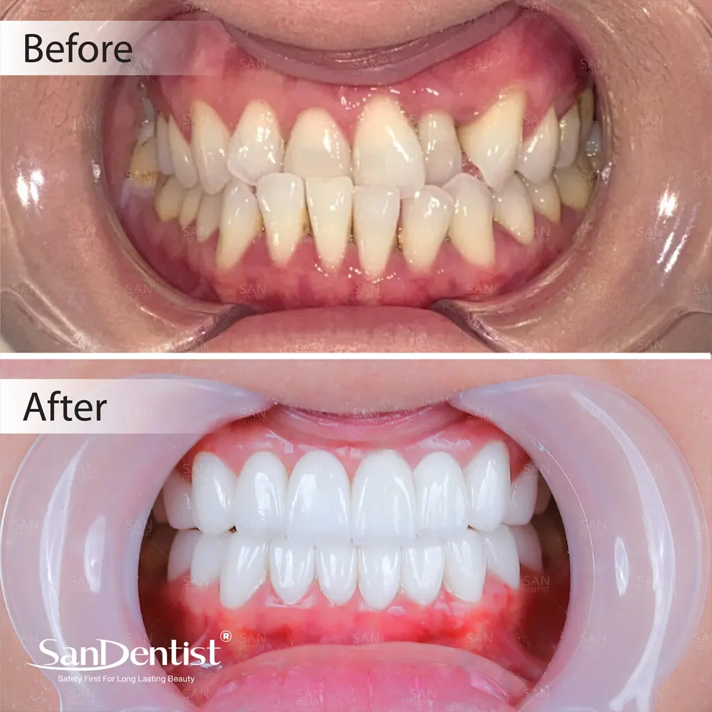 Mất răng số 7 có nên trồng lại hay không?