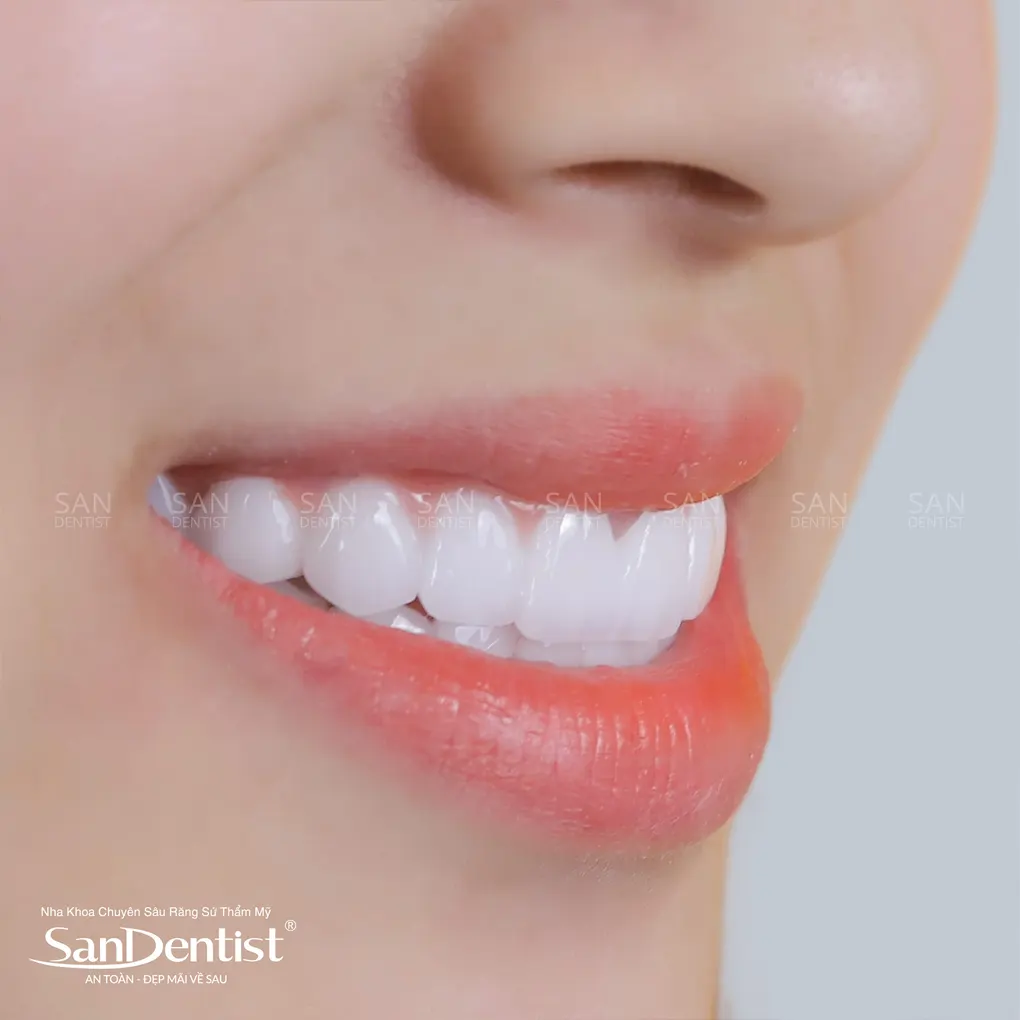 Nhổ răng khôn hàm trên có nguy hiểm không?