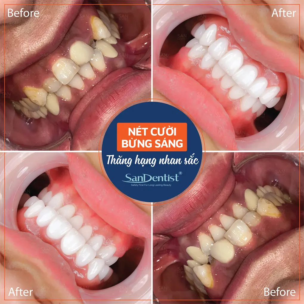 Nhổ răng khôn quên cắt chỉ gây hậu quả gì?