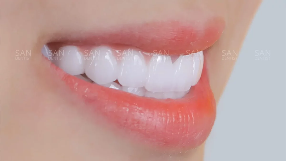 Răng bị gãy cần được chăm sóc như thế nào? 