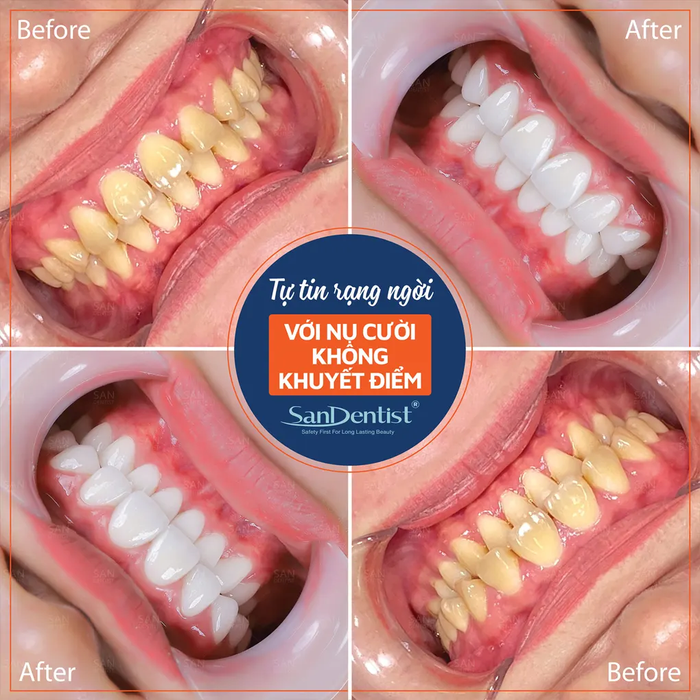 Răng hàm vỡ chỉ còn chân răng có nguy hiểm không?