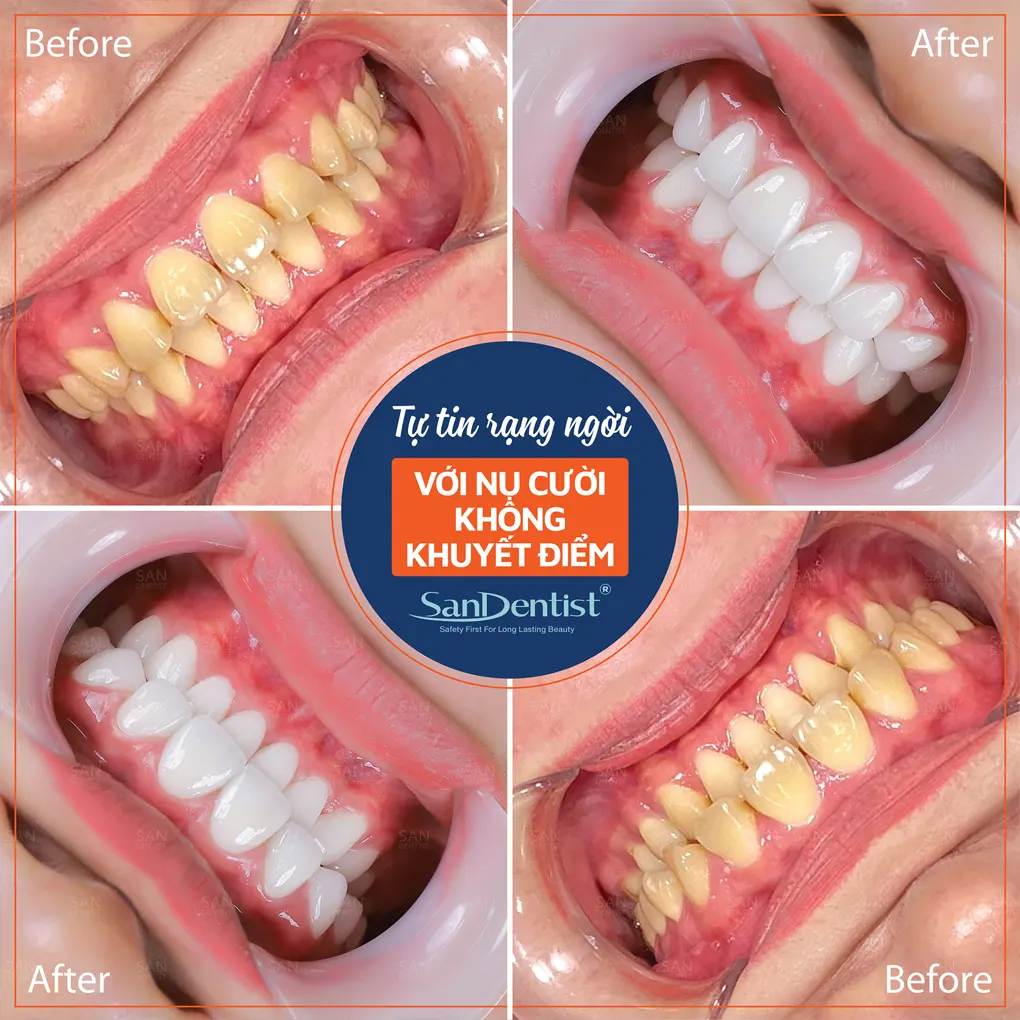 Răng lấy tủy bị vỡ cần khắc phục như thế nào?