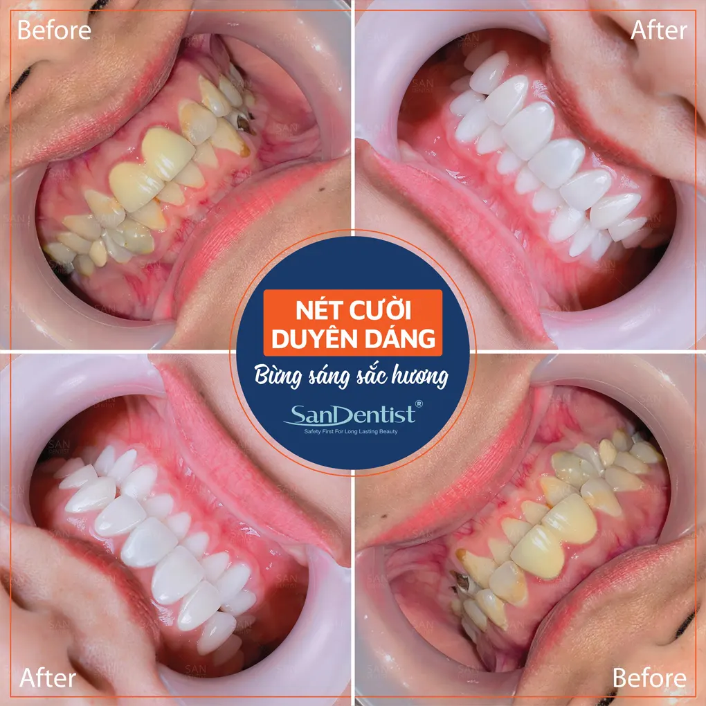 Răng lệch khớp cắn gây ra những tác hại gì?