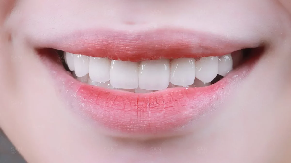 Răng lệch khớp cắn gây ra những tác hại gì?