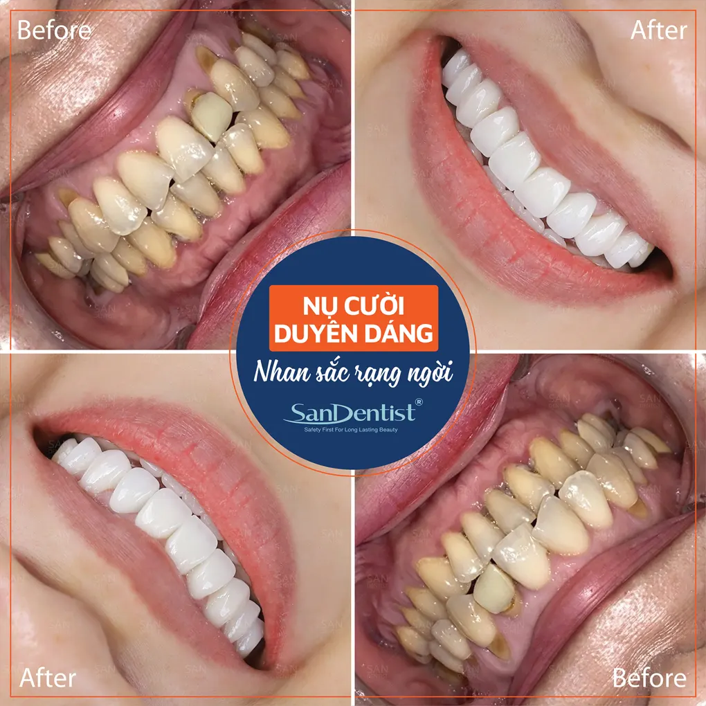 Răng nhiễm fluor cần điều trị như thế nào?