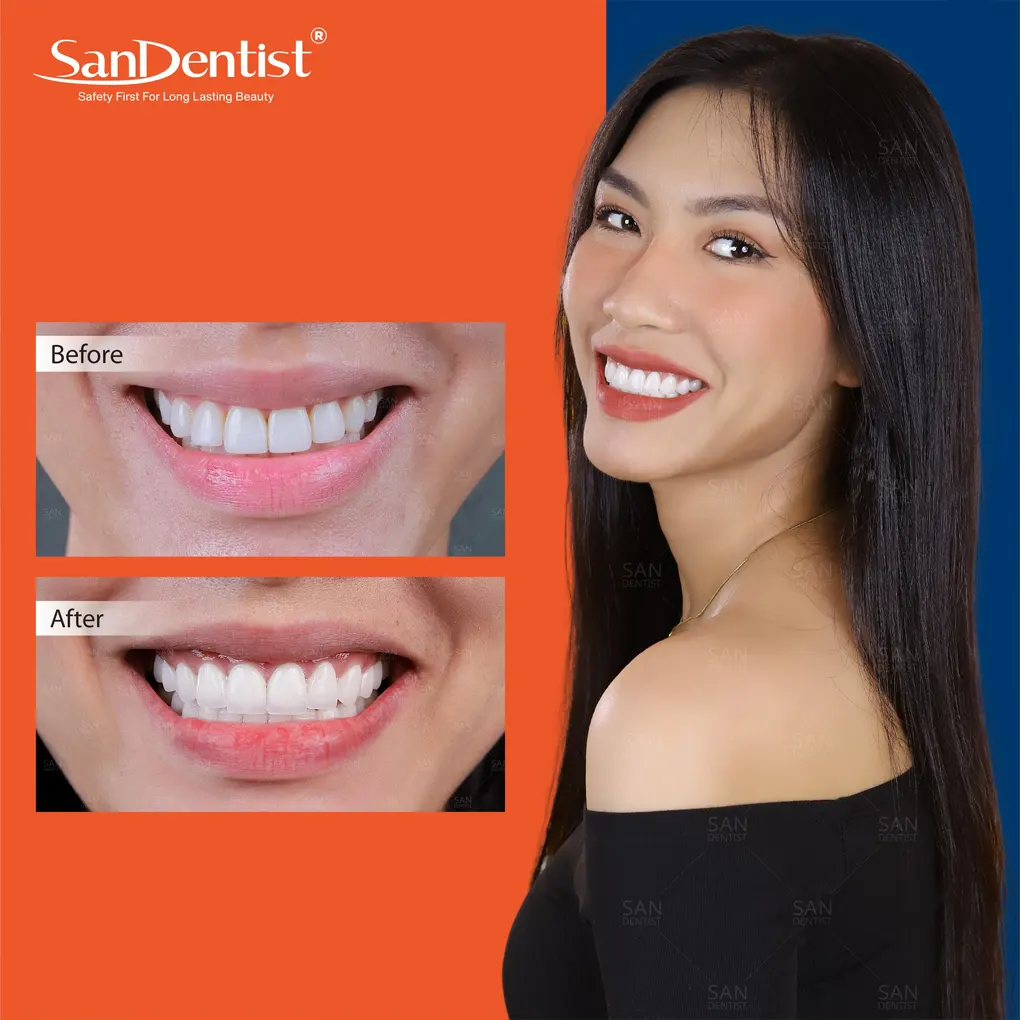 Tiêu xương răng có gây nguy hiểm không?