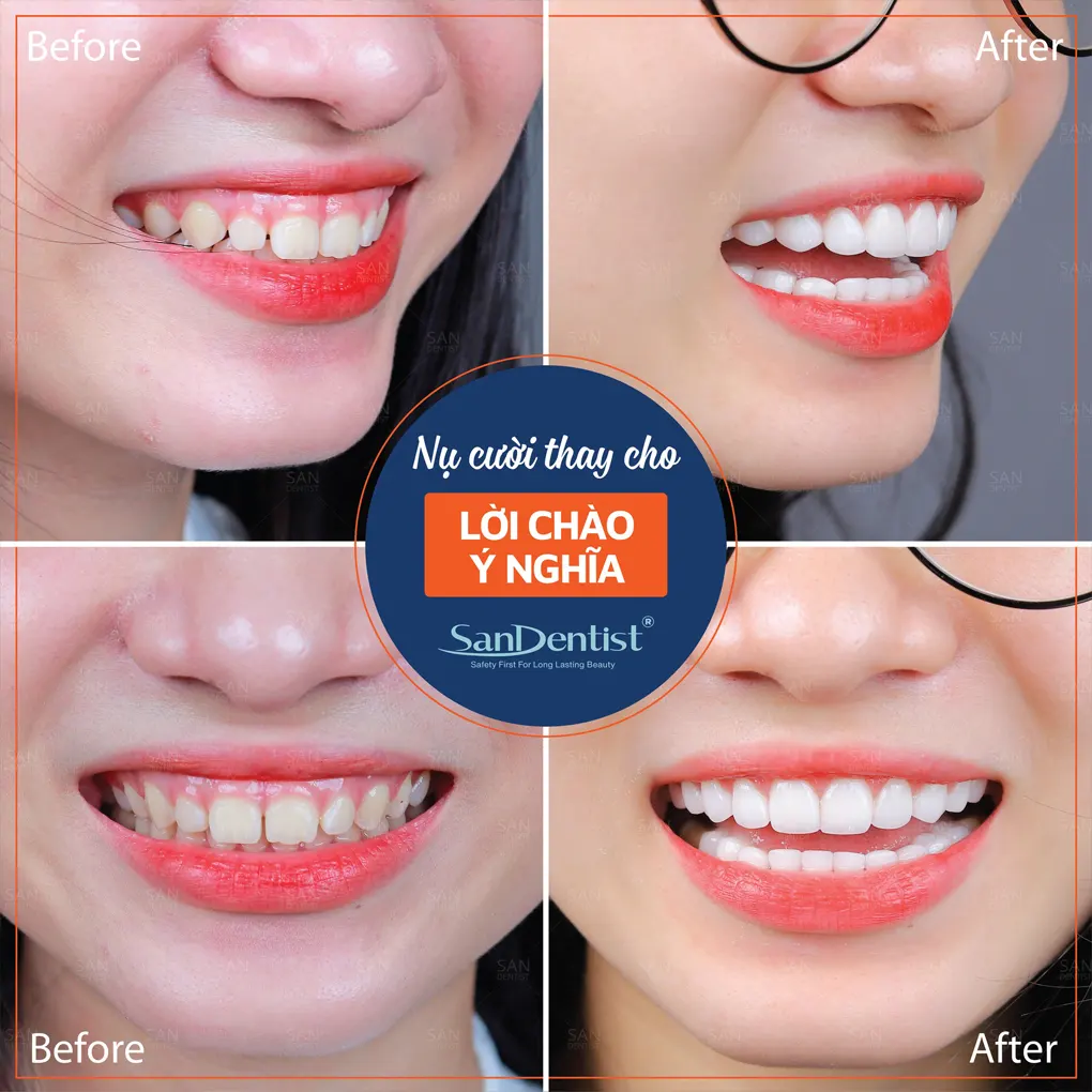 Tình trạng tụt lợi có điều trị được hay không?