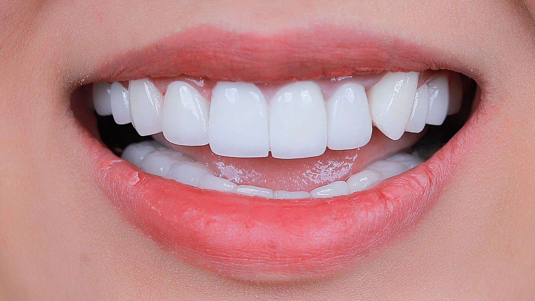 Trồng răng giả và những điều cần lưu ý?