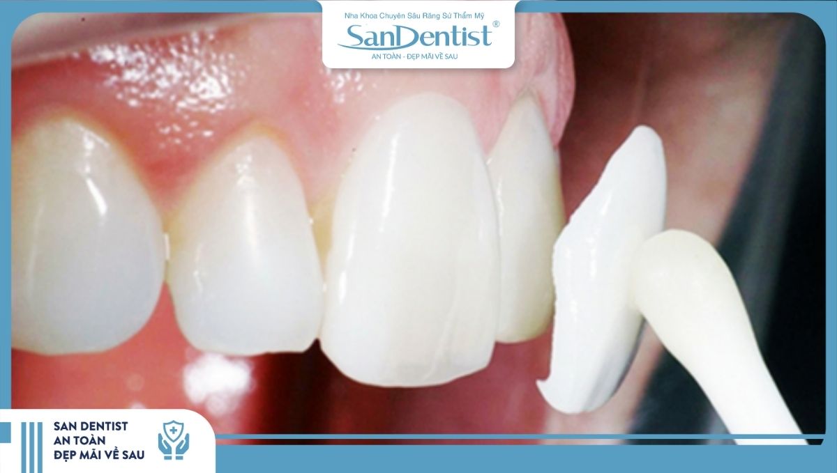 Bạn nên lựa chọn cơ sở nha khoa uy tín để dán sứ veneer