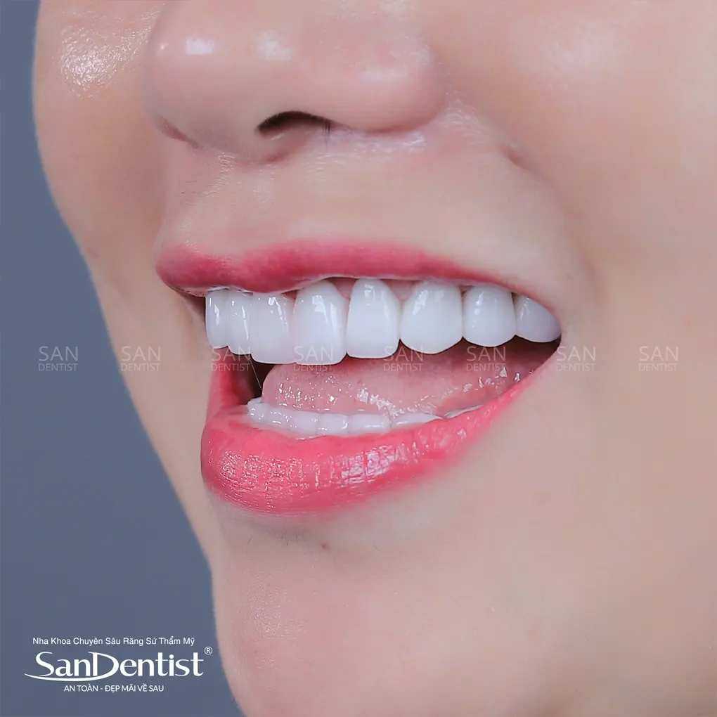 Bao nhiêu tuổi sẽ xuất hiện cao răng?