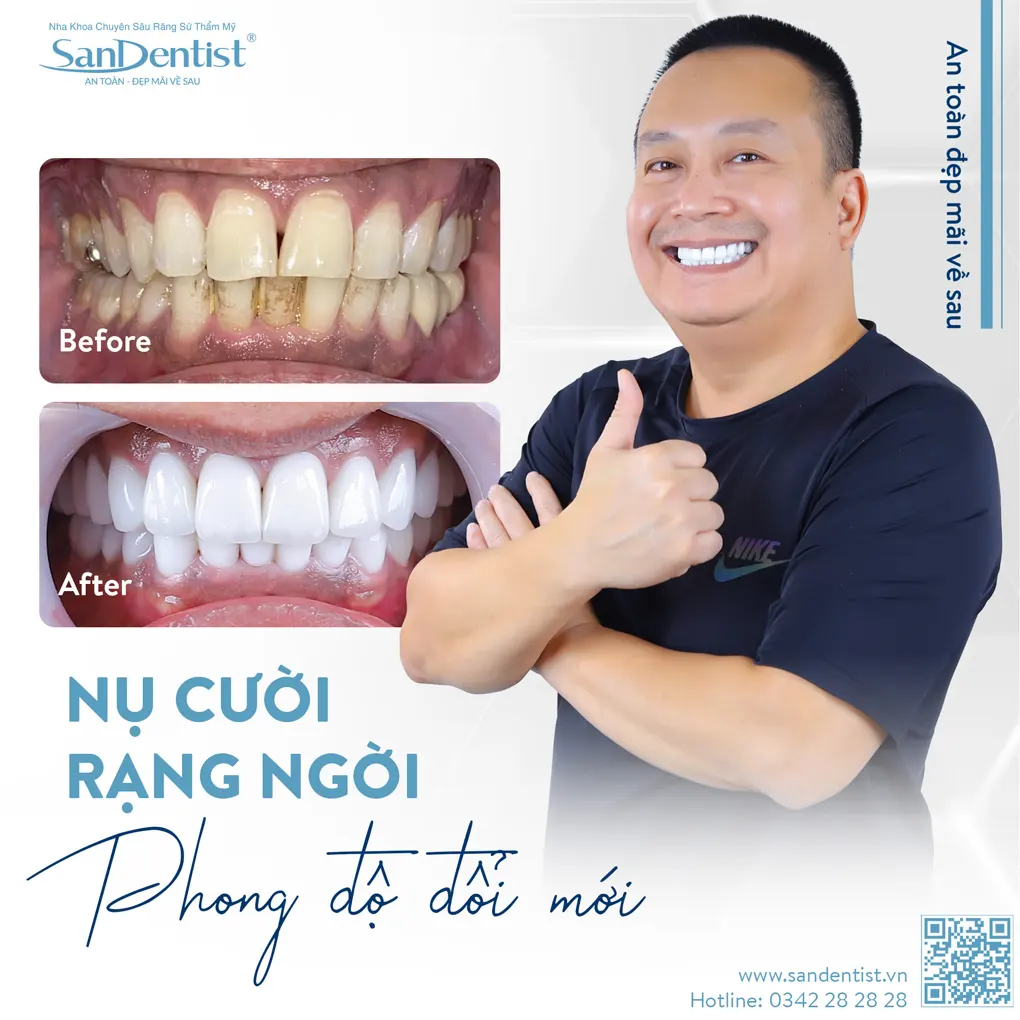 Bao nhiêu tuổi sẽ xuất hiện cao răng?