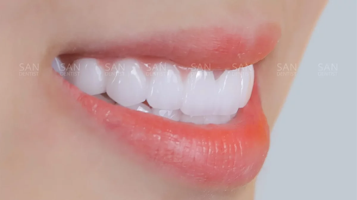 Bao nhiêu tuổi sẽ xuất hiện cao răng?