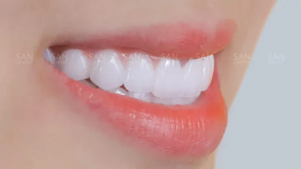 Bao nhiêu tuổi sẽ xuất hiện cao răng?