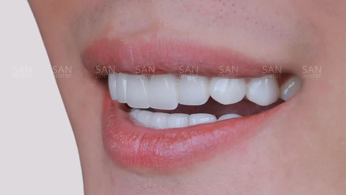 Bị sốt và đau đầu sau nhổ răng xử lý như thế nào?