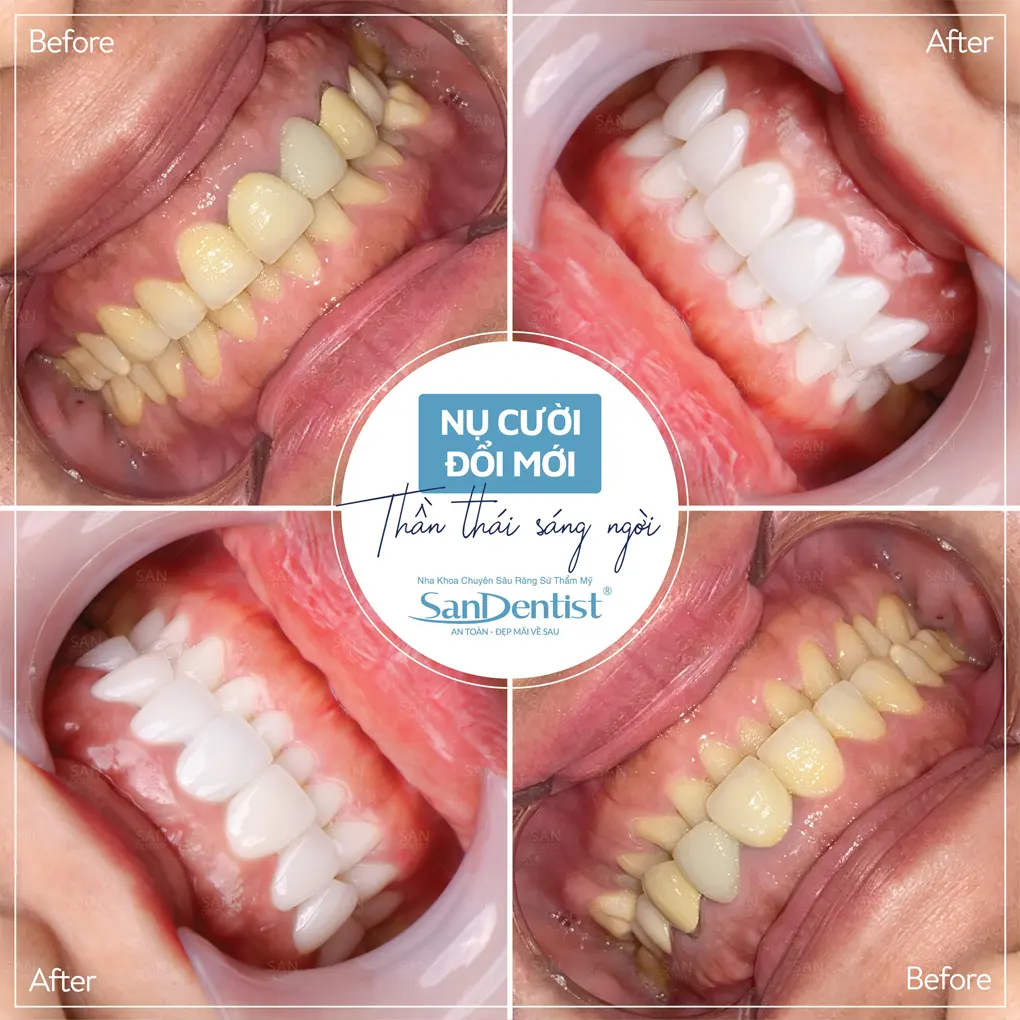 Biện pháp ngăn chặn tình trạng chảy máu răng 