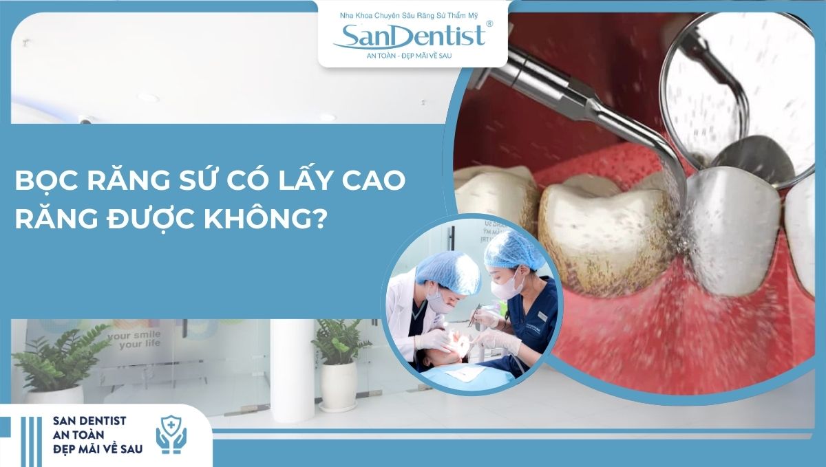 Bọc răng sứ có lấy cao răng được không